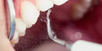 Удаление зубного камня