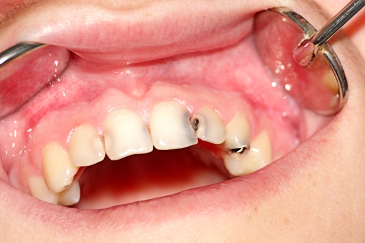 Развитие кариеса