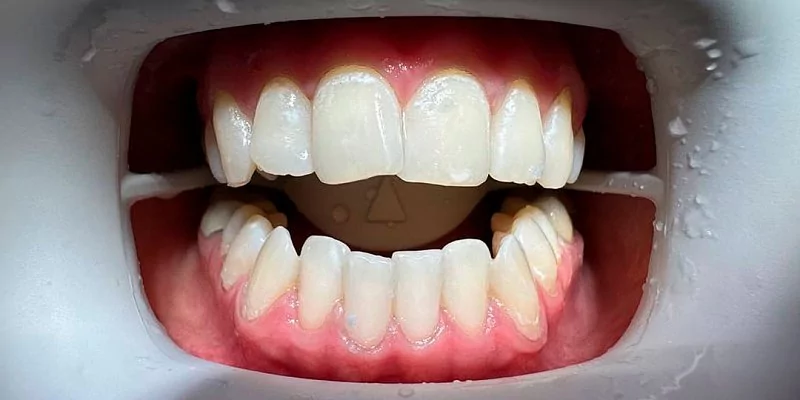 После - Профессиональная чистка зубов